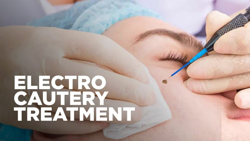 Essential Tips for Electrocautery Aftercare